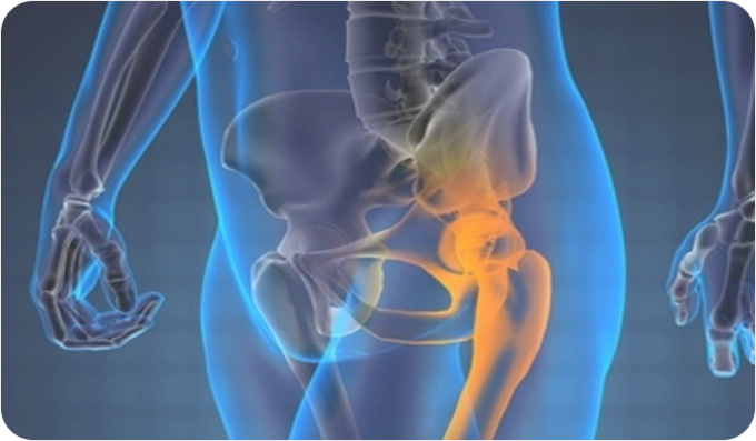 대퇴골두 골괴사(무혈성괴사) Osteonecrosis of the Femoral Head